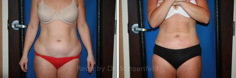 RENU by Dr. Philip S Schoenfeld (Plastic Surgeon) liposuction result — Chevy Chase, MD