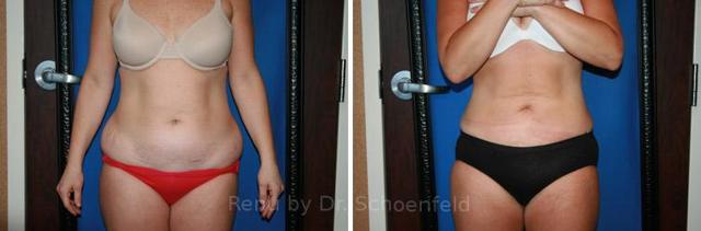 Brazilian Butt Lift result at RENU by Dr. Philip S Schoenfeld (Plastic Surgeon) in Chevy Chase, MD