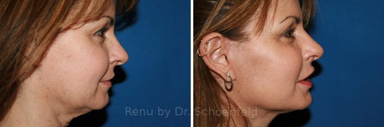 RENU by Dr. Philip S Schoenfeld (Plastic Surgeon) facelift result — Chevy Chase, MD