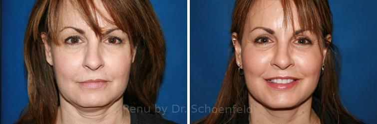 RENU by Dr. Philip S Schoenfeld (Plastic Surgeon) facelift result — Chevy Chase, MD