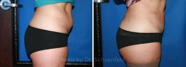 Liposuction result at RENU by Dr. Philip S Schoenfeld (Plastic Surgeon) in Chevy Chase, MD