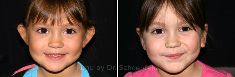 RENU by Dr. Philip S Schoenfeld (Plastic Surgeon) otoplasty result — Chevy Chase, MD
