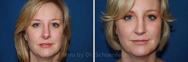 Functional Rhinoplasty result at RENU by Dr. Philip S Schoenfeld (Plastic Surgeon) in Chevy Chase, MD