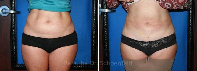 Liposuction result at RENU by Dr. Philip S Schoenfeld (Plastic Surgeon) in Chevy Chase, MD