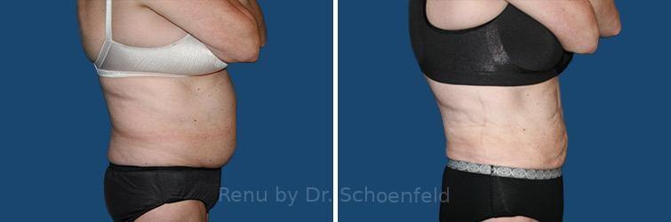 RENU by Dr. Philip S Schoenfeld (Plastic Surgeon) liposuction result — Chevy Chase, MD