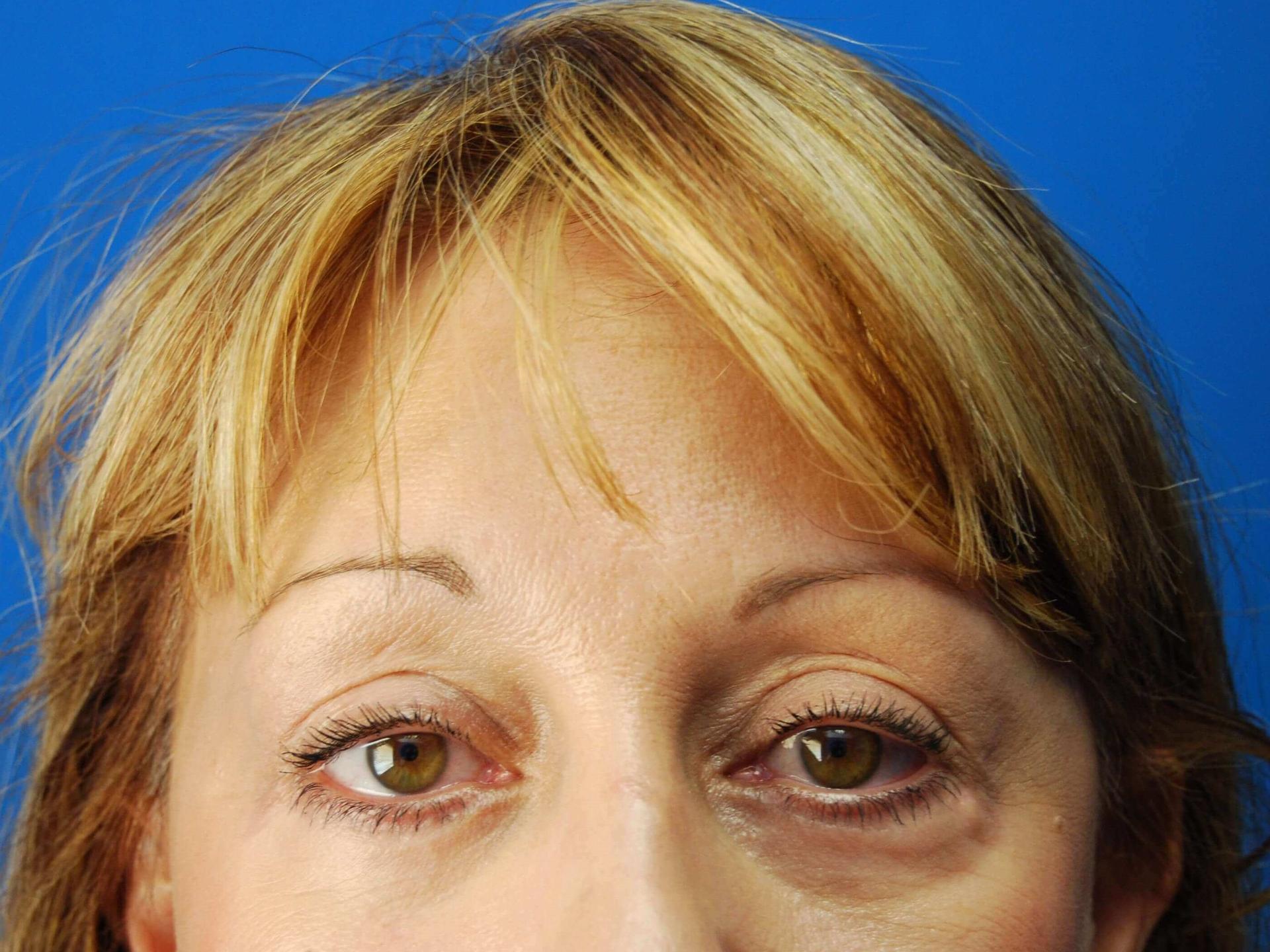 St. Petersburg Center for Plastic Surgery eyelid lift after — St. Petersburg, FL