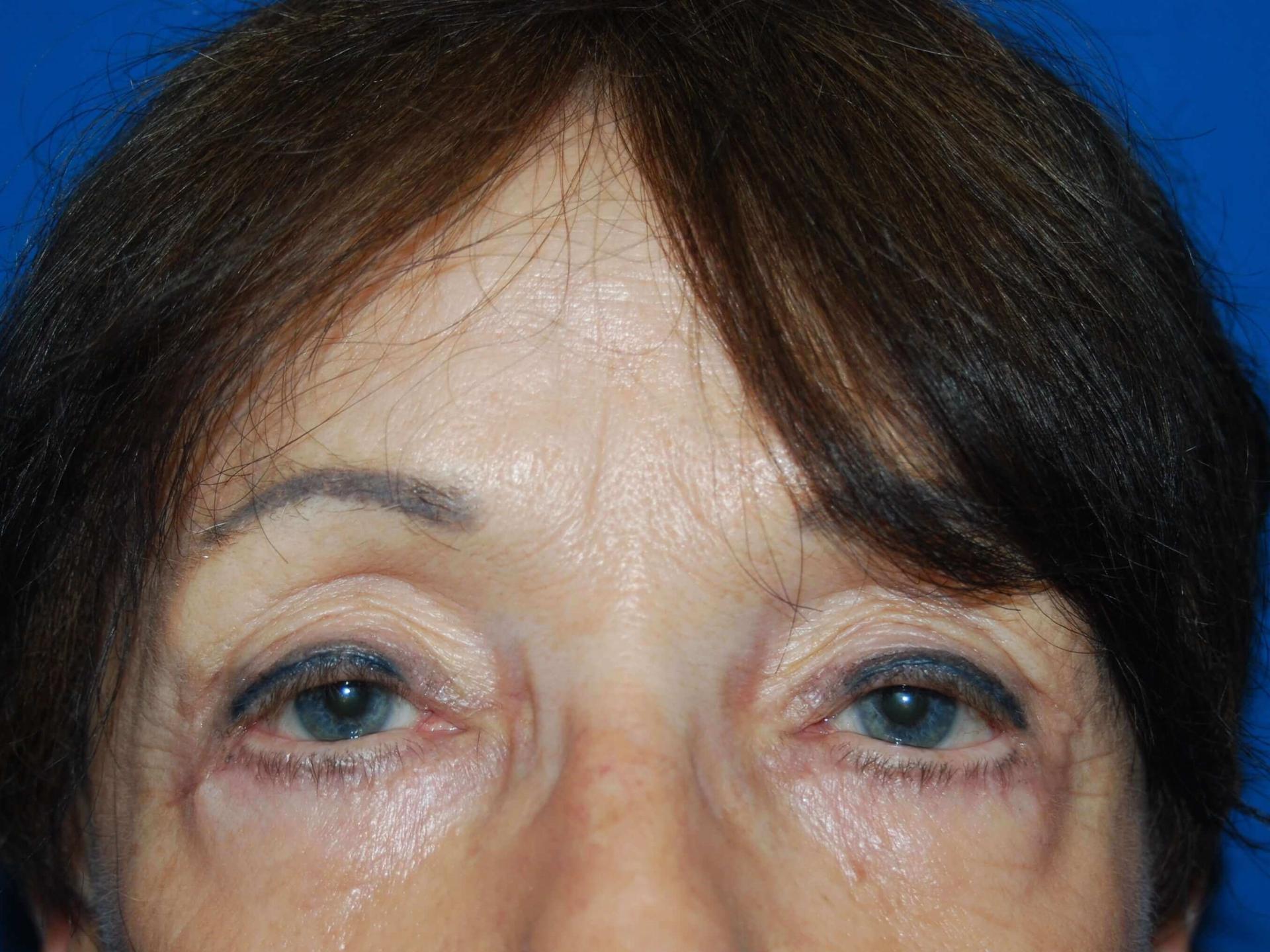 St. Petersburg Center for Plastic Surgery eyelid lift after — St. Petersburg, FL
