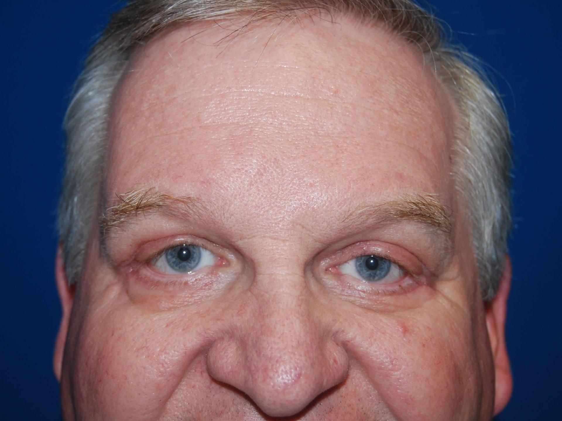 St. Petersburg Center for Plastic Surgery eyelid lift after — St. Petersburg, FL