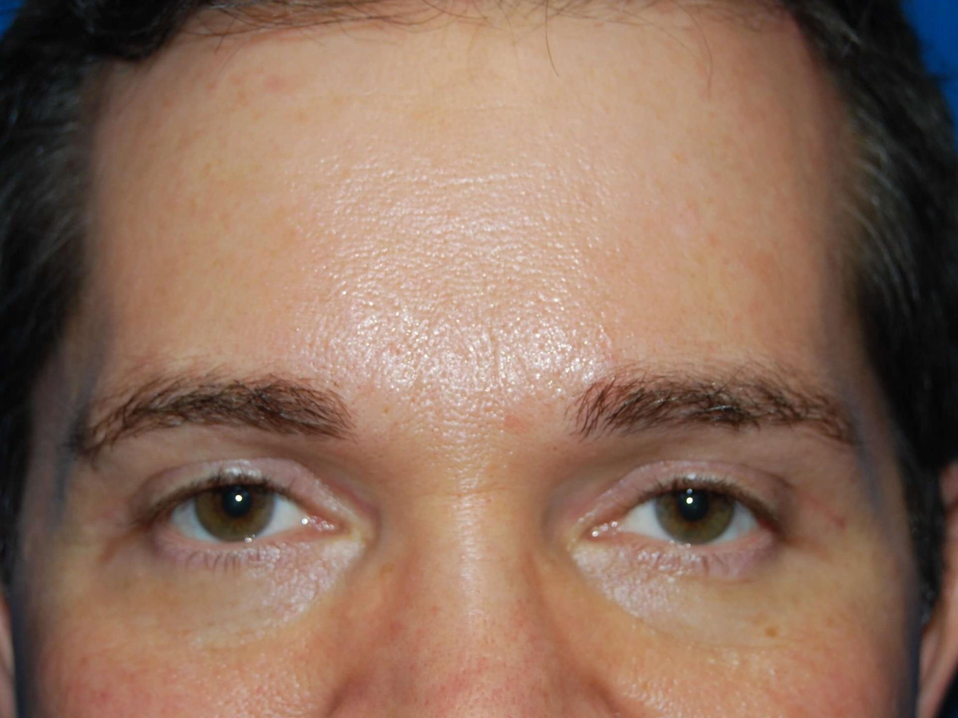 St. Petersburg Center for Plastic Surgery brow lift after — St. Petersburg, FL