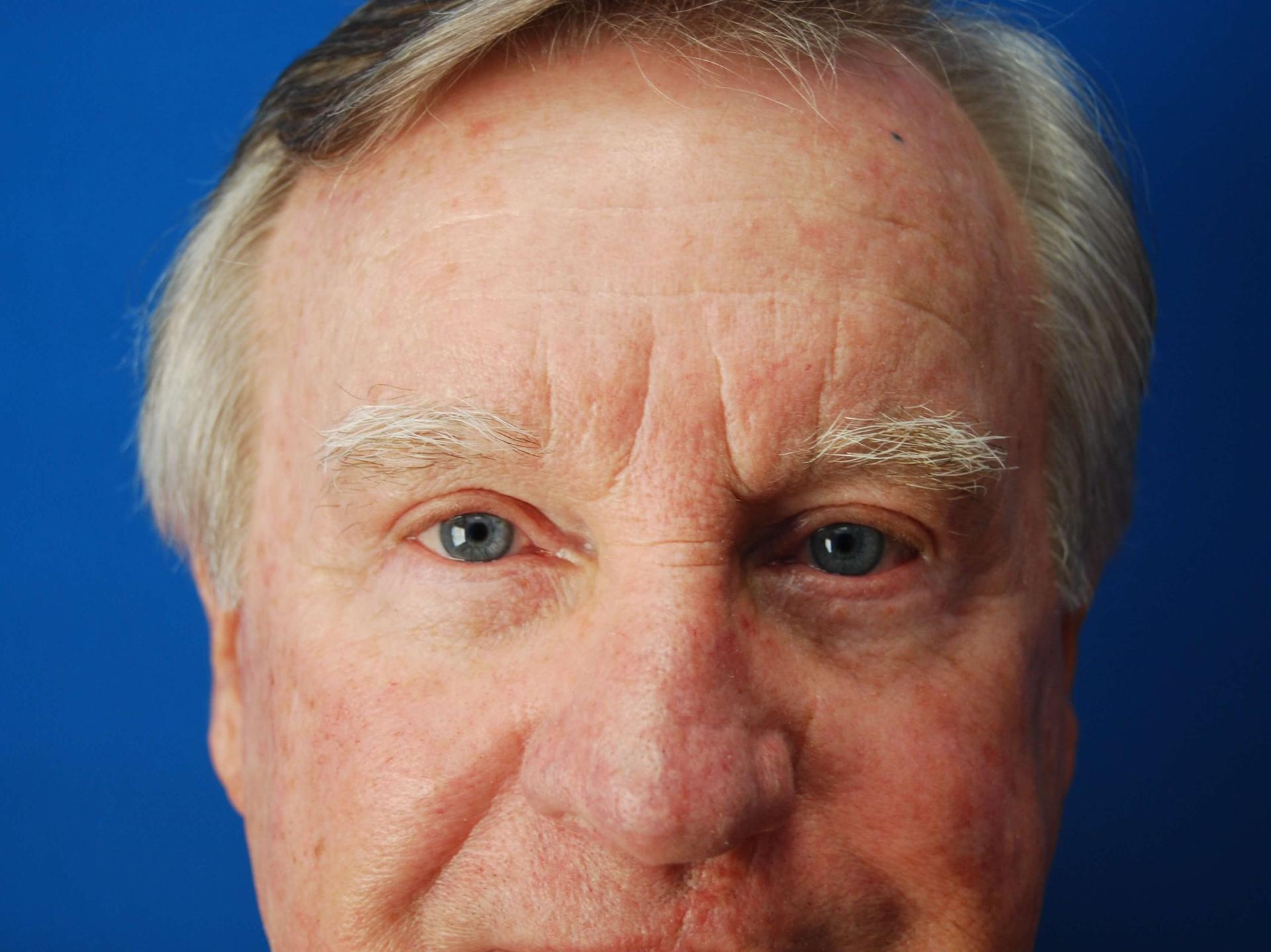 St. Petersburg Center for Plastic Surgery eyelid lift after — St. Petersburg, FL