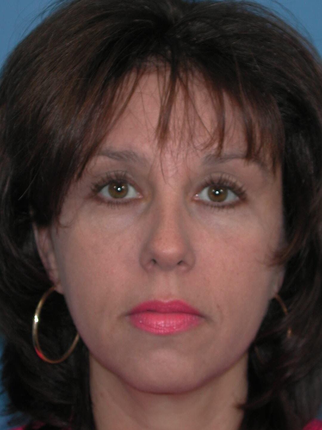 St. Petersburg Center for Plastic Surgery brow lift after — St. Petersburg, FL