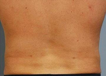 Beverly Hills Institute of Plastic Surgery liposuction after — Brea, CA