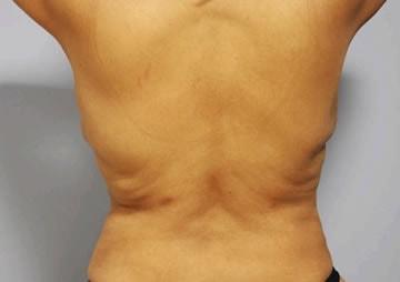 Beverly Hills Institute of Plastic Surgery liposuction after — Brea, CA