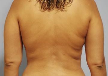 Beverly Hills Institute of Plastic Surgery liposuction after — Brea, CA