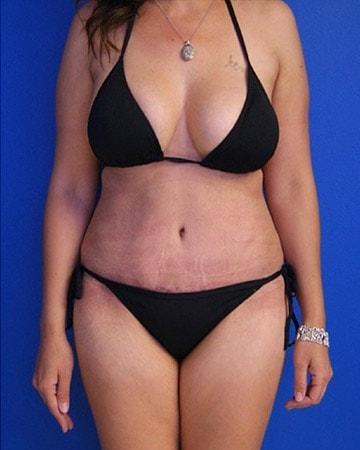 Beverly Hills Institute of Plastic Surgery tummy tuck after — Brea, CA