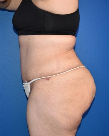 Beverly Hills Institute of Plastic Surgery tummy tuck after — Brea, CA