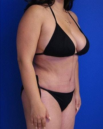 Beverly Hills Institute of Plastic Surgery tummy tuck after — Brea, CA