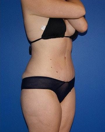Beverly Hills Institute of Plastic Surgery tummy tuck after — Brea, CA