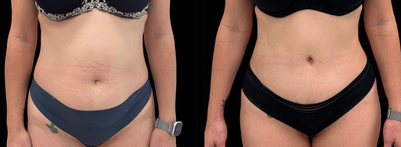 Inspire Aesthetics tummy tuck result — Delray Beach, FL