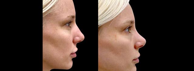Rhinoplasty result at Inspire Aesthetics in Delray Beach, FL