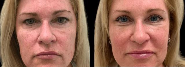 Blepharoplasty result at Inspire Aesthetics in Delray Beach, FL