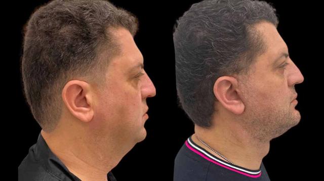 Neck Lift result at Inspire Aesthetics in Delray Beach, FL