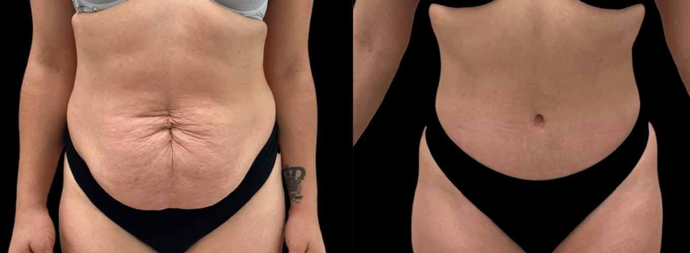 Inspire Aesthetics tummy tuck result — Delray Beach, FL