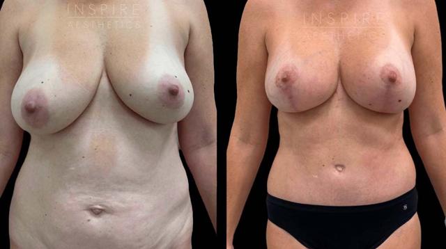 Mommy Makeover result at Inspire Aesthetics in Delray Beach, FL