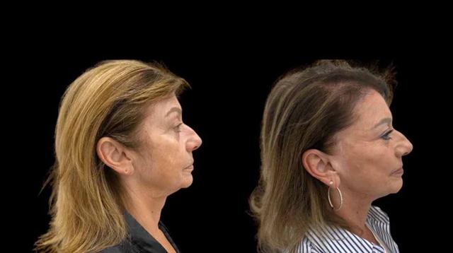 Neck Lift result at Inspire Aesthetics in Delray Beach, FL