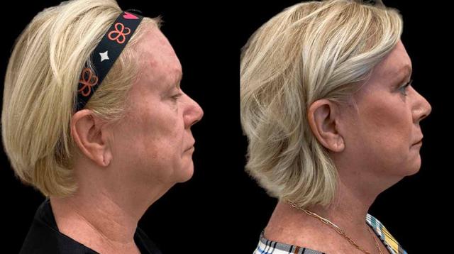 Neck Lift result at Inspire Aesthetics in Delray Beach, FL