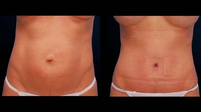 Mommy Makeover result at Inspire Aesthetics in Delray Beach, FL