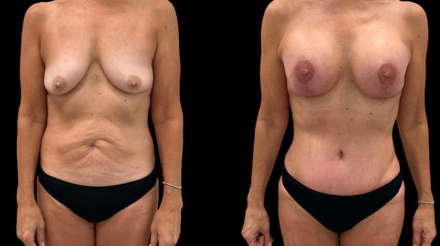 Mommy Makeover result at Inspire Aesthetics in Delray Beach, FL