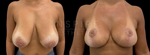 Breast Reduction result at Inspire Aesthetics in Delray Beach, FL