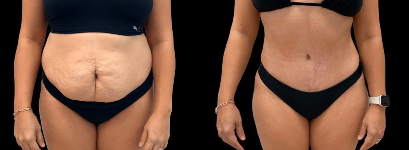 Inspire Aesthetics tummy tuck result — Delray Beach, FL