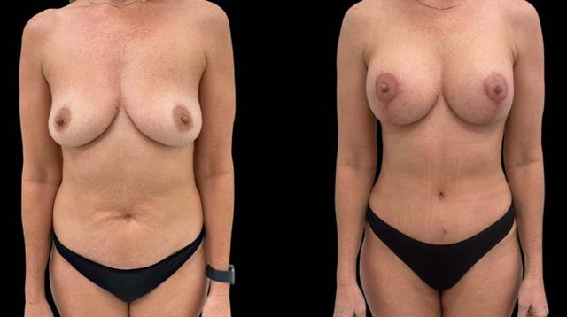 Mommy Makeover result at Inspire Aesthetics in Delray Beach, FL