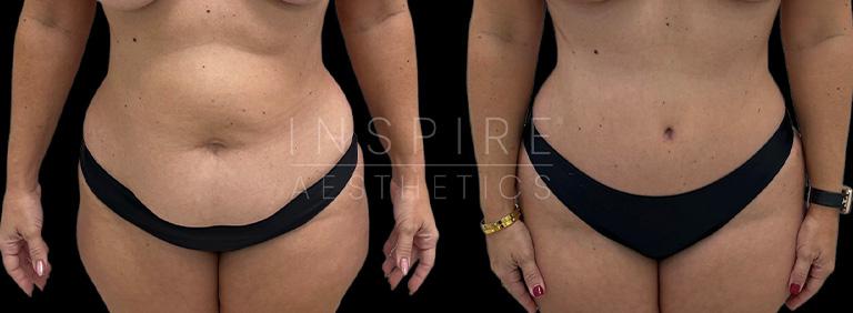 Inspire Aesthetics tummy tuck result — Delray Beach, FL