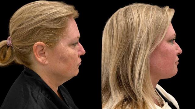 Neck Lift result at Inspire Aesthetics in Delray Beach, FL
