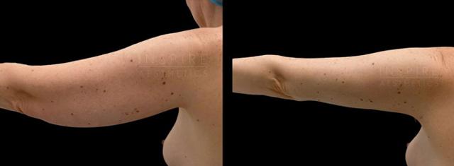 Arm Lift result at Inspire Aesthetics in Delray Beach, FL