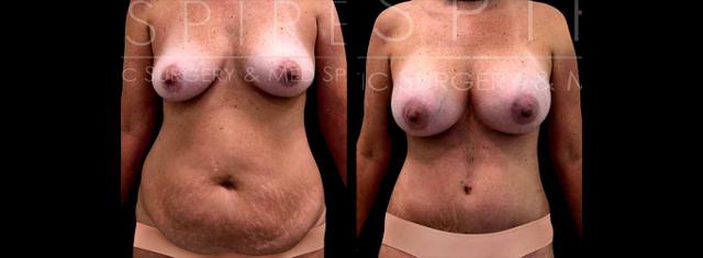 Tummy Tuck result at Inspire Aesthetics in Delray Beach, FL