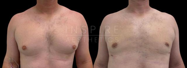 Gynecomastia Surgery result at Inspire Aesthetics in Delray Beach, FL