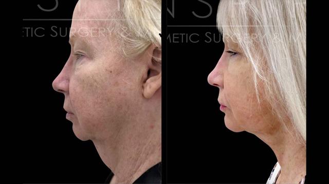 Chin Implant result at Inspire Aesthetics in Delray Beach, FL