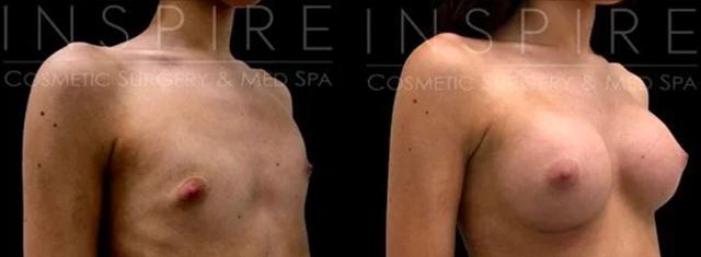 Breast Augmentation result at Inspire Aesthetics in Delray Beach, FL