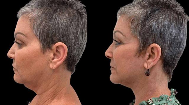 Neck Lift result at Inspire Aesthetics in Delray Beach, FL