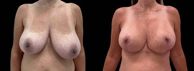 Breast Reduction result at Inspire Aesthetics in Delray Beach, FL