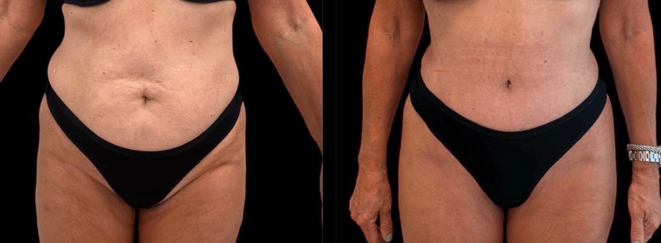 Inspire Aesthetics tummy tuck result — Delray Beach, FL