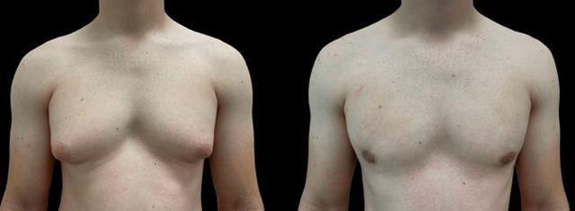 Gynecomastia Surgery result at Inspire Aesthetics in Delray Beach, FL
