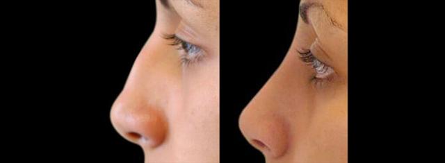 Rhinoplasty result at Inspire Aesthetics in Delray Beach, FL