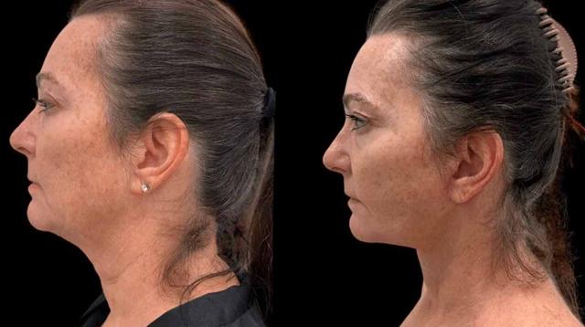 Neck Lift result at Inspire Aesthetics in Delray Beach, FL