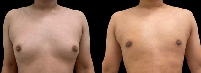 Gynecomastia Surgery result at Inspire Aesthetics in Delray Beach, FL
