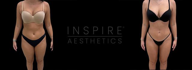 Brazilian Butt Lift result at Inspire Aesthetics in Delray Beach, FL
